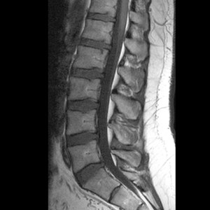 Bolest chrbta v driekovej oblasti Rehabilitacia Orac MRI scan