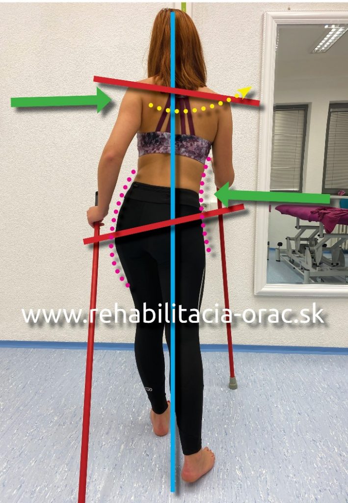 Nordic walking rehabilitacia Orac fyzioterapia